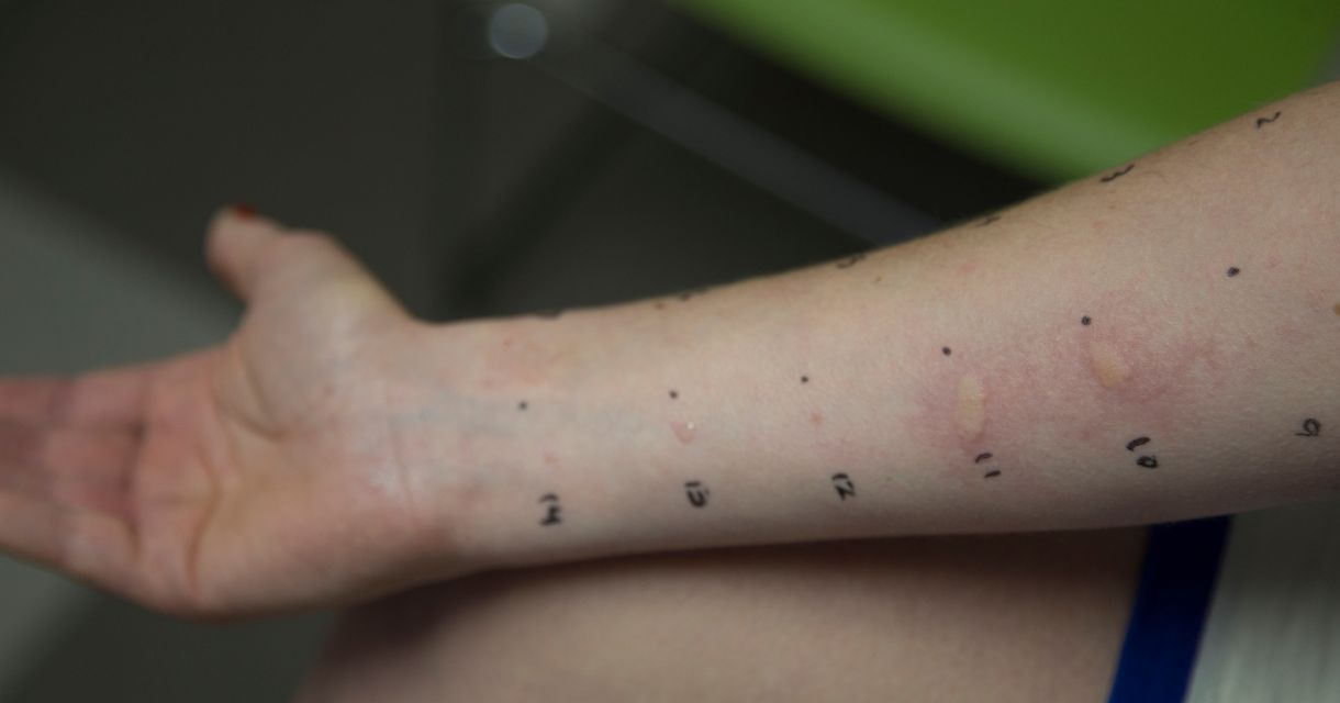 allergy testing