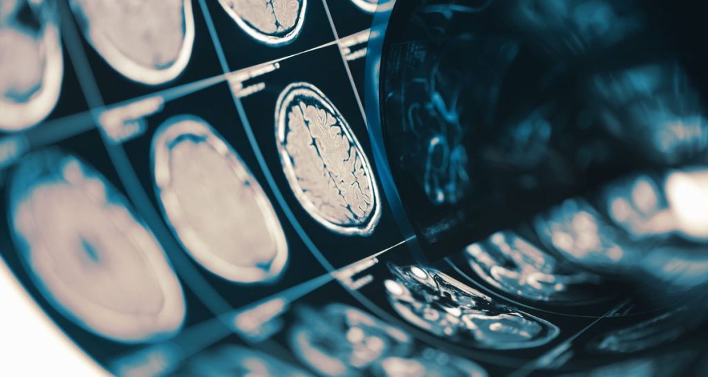 Acromegaly Risks