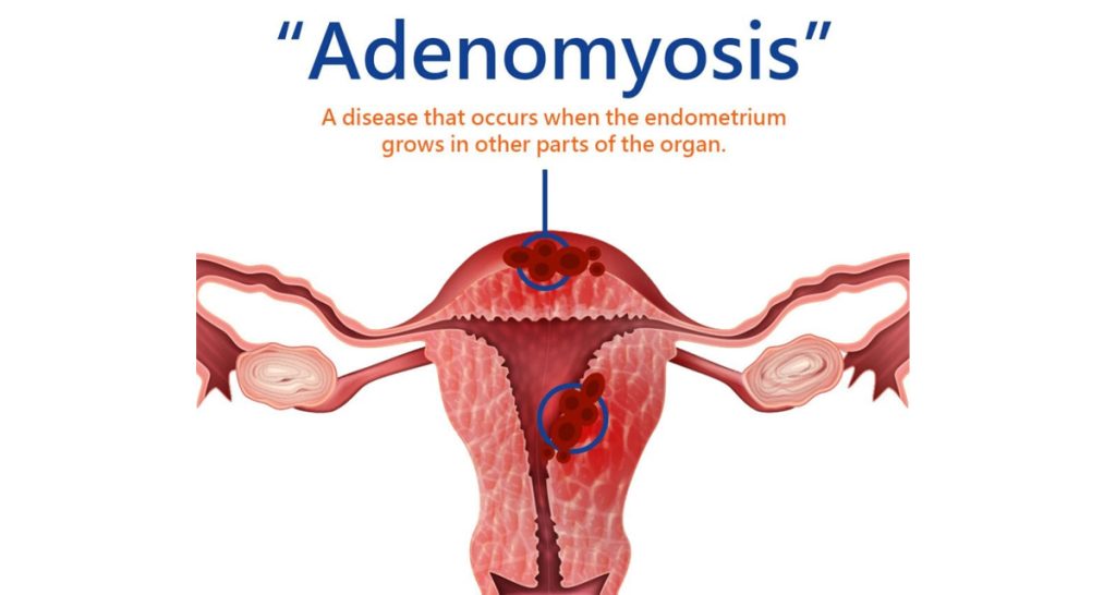Adenomyosis