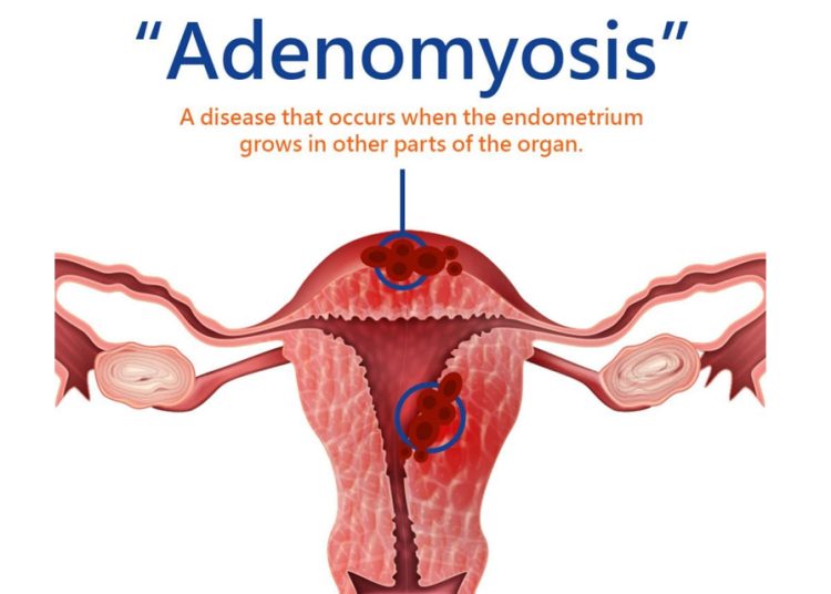 Adenomyosis
