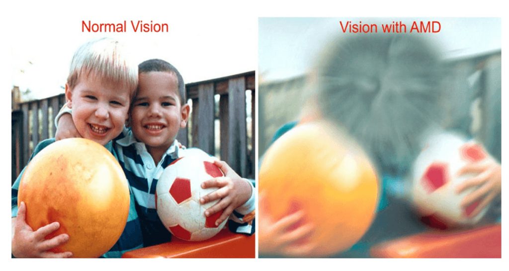 Age-Related Macular Degeneration