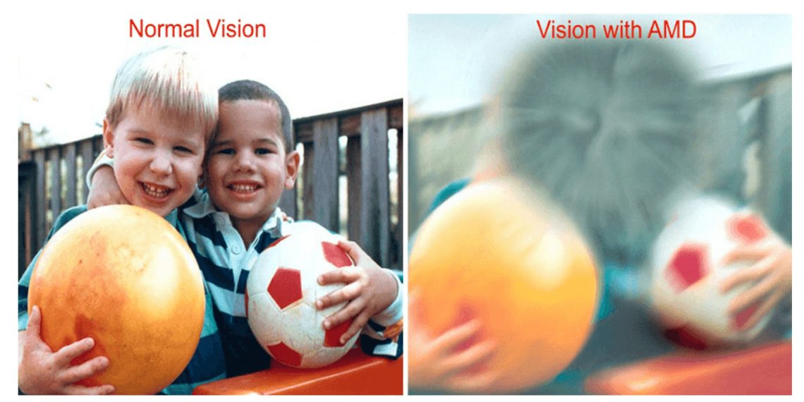 Age-Related Macular Degeneration