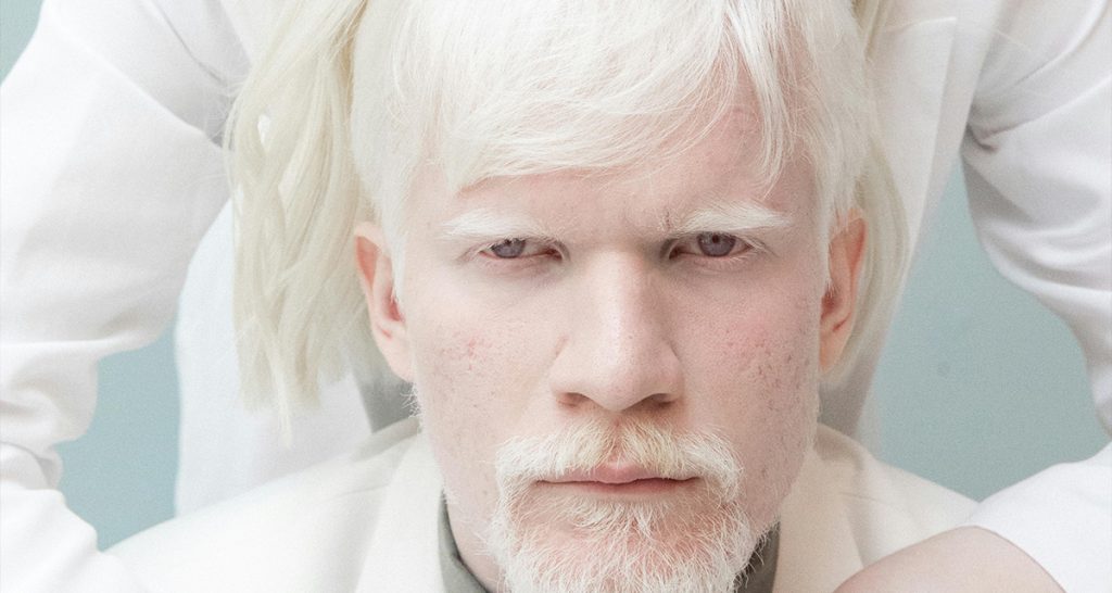 Albinism