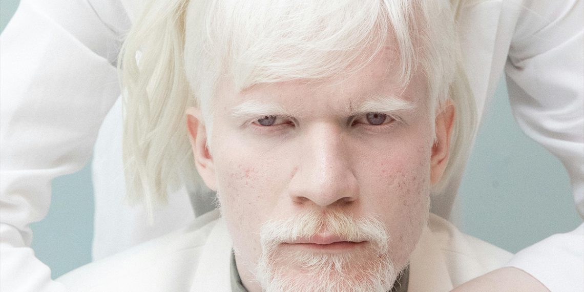 Albinism