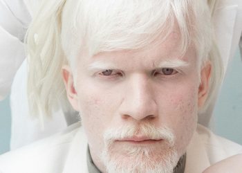 Albinism