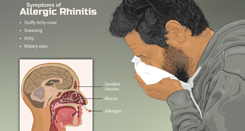 Allergic Rhinitis