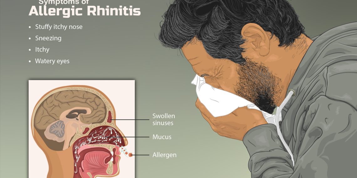 Allergic Rhinitis