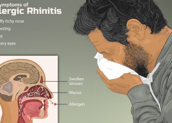 Allergic Rhinitis
