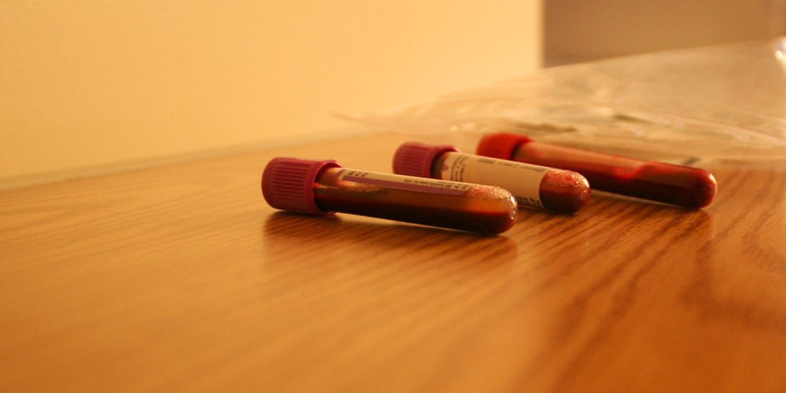 Amniocentesis Results and What They Mean