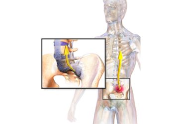 Ankylosing Spondylitis