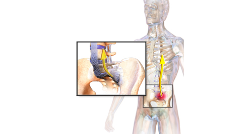Ankylosing Spondylitis