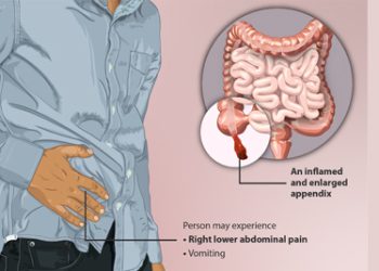 Appendicitis