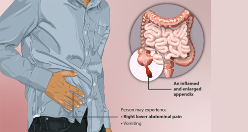 Appendicitis