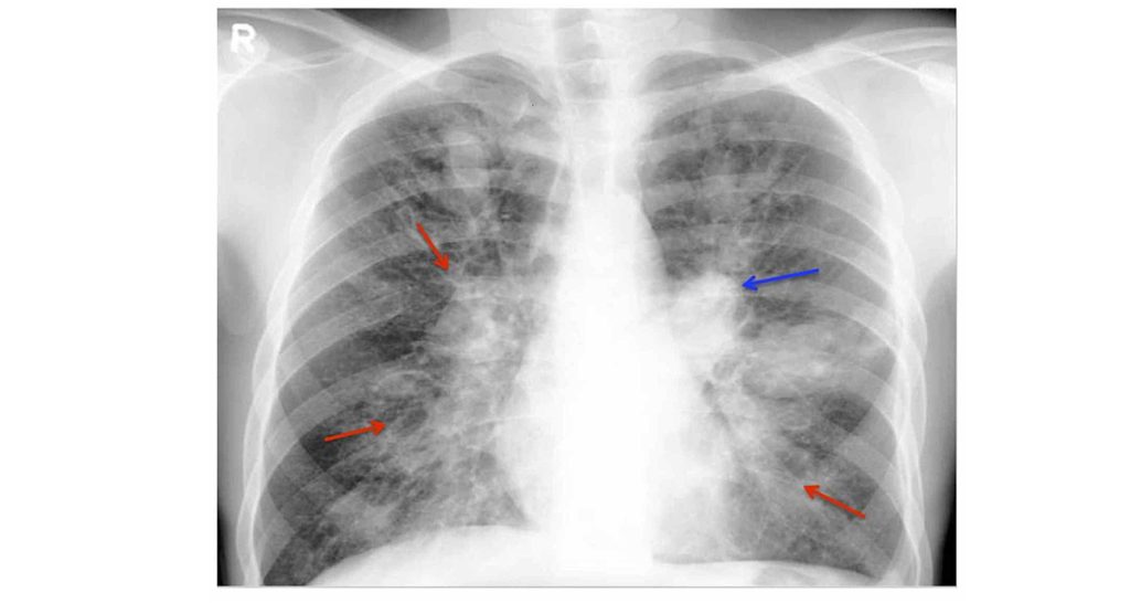 Aspergillosis