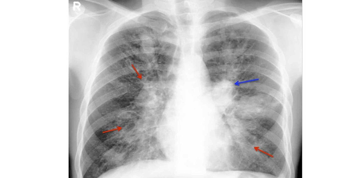 Aspergillosis