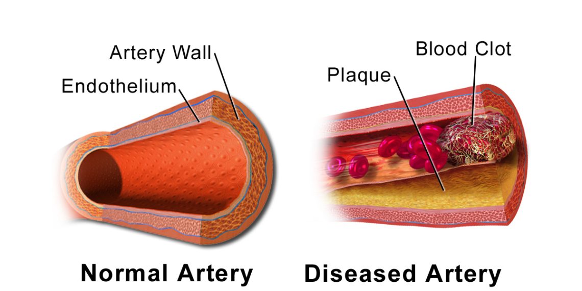 Atherosclerosis