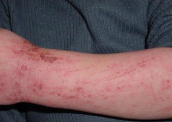 Atopic Eczema