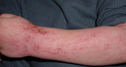 Atopic Eczema