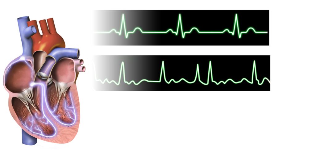 Atrial Fibrillation