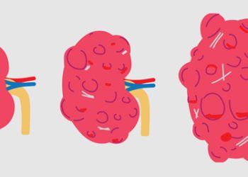 Illustration showing progression of ADPKD from a normal kidney to cyst-filled polycystic kidney.