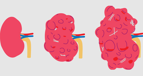 Illustration showing progression of ADPKD from a normal kidney to cyst-filled polycystic kidney.