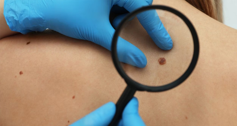 Dermatologist examining a mole-like birthmark on a patient’s back using gloves and a magnifying glass.