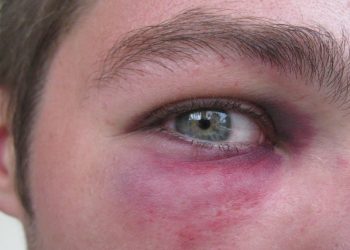 Close-up of a man's eye with visible bruising and discolouration, showing symptoms of a black eye.
