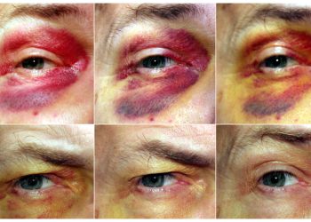 Progressive images of a healing black eye, showing colour changes from red to yellow over several days.