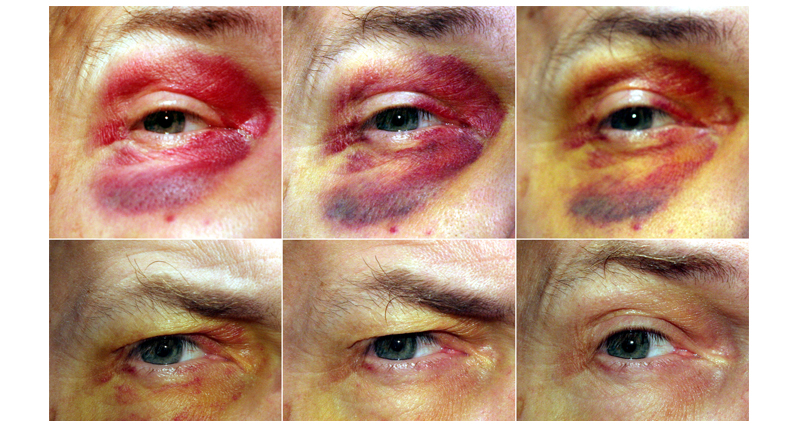 Progressive images of a healing black eye, showing colour changes from red to yellow over several days.