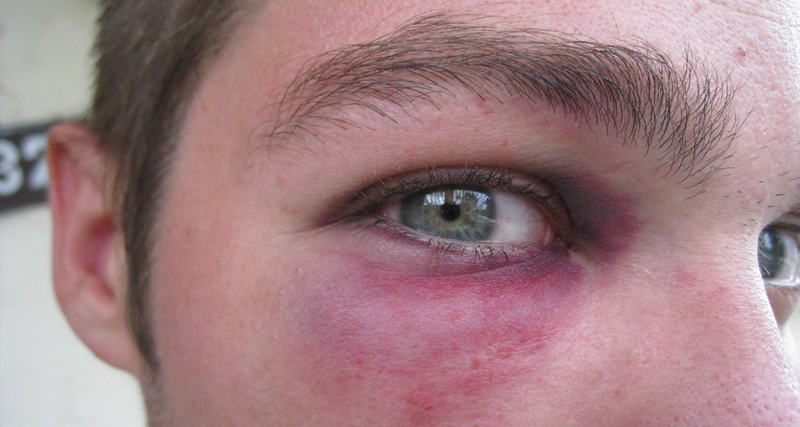 Close-up of a man's eye with visible bruising and discolouration, showing symptoms of a black eye.