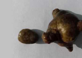 Two removed bladder stones of varying size and shape placed on a white background for clinical observation.