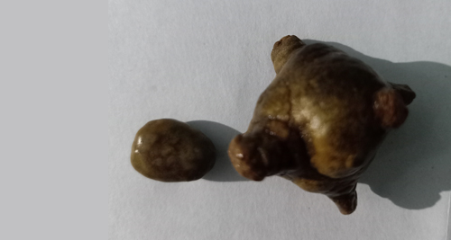 Two removed bladder stones of varying size and shape placed on a white background for clinical observation.