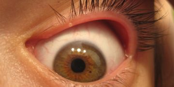 Close-up of an inflamed eyelid showing signs of blepharitis with visible redness and irritation.