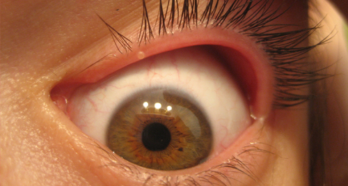 Close-up of an inflamed eyelid showing signs of blepharitis with visible redness and irritation.