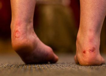 Close-up of feet with visible blisters on the heels caused by friction, likely from footwear.
