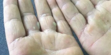 Close-up of a person’s palms showing several fluid-filled blisters, indicating possible skin irritation or infection.