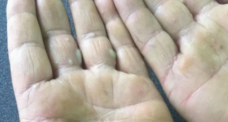 Close-up of a person’s palms showing several fluid-filled blisters, indicating possible skin irritation or infection.