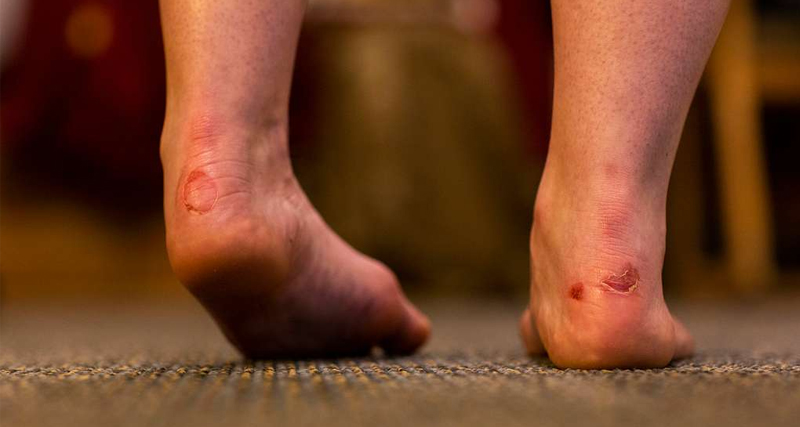 Close-up of feet with visible blisters on the heels caused by friction, likely from footwear.