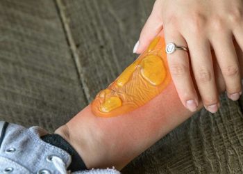 Boil on leg with a protective transparent dressing and surrounding redness being treated by hand.
