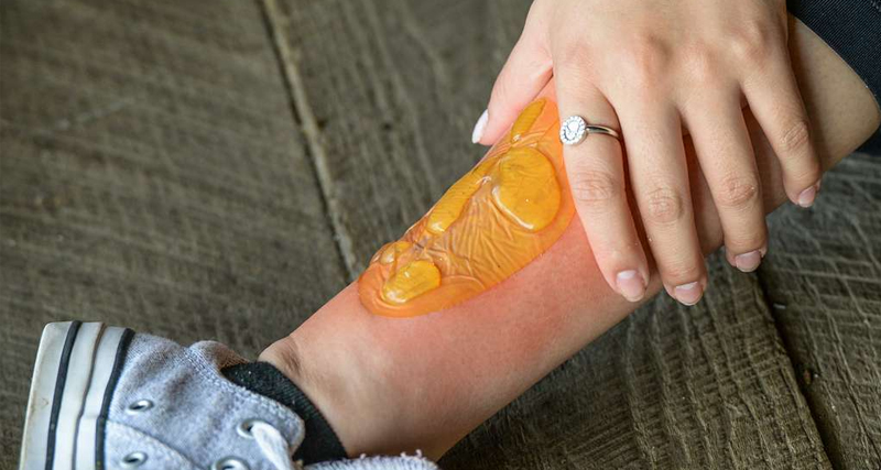 Boil on leg with a protective transparent dressing and surrounding redness being treated by hand.