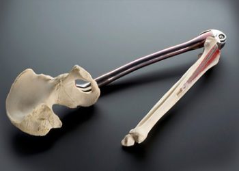 Prosthetic model showing a human femur and hip bone replacement, often used in advanced bone cancer cases.
