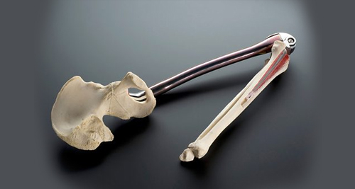 Prosthetic model showing a human femur and hip bone replacement, often used in advanced bone cancer cases.