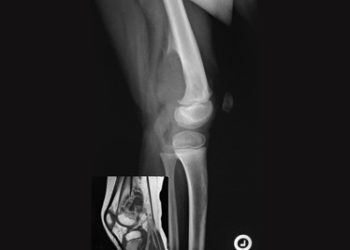X-ray image of a bone cyst visible in the femur, showing a radiolucent lesion with defined borders.