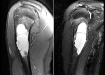 MRI scans showing bone cysts in the upper arm, typically used in diagnosis and follow-up imaging.