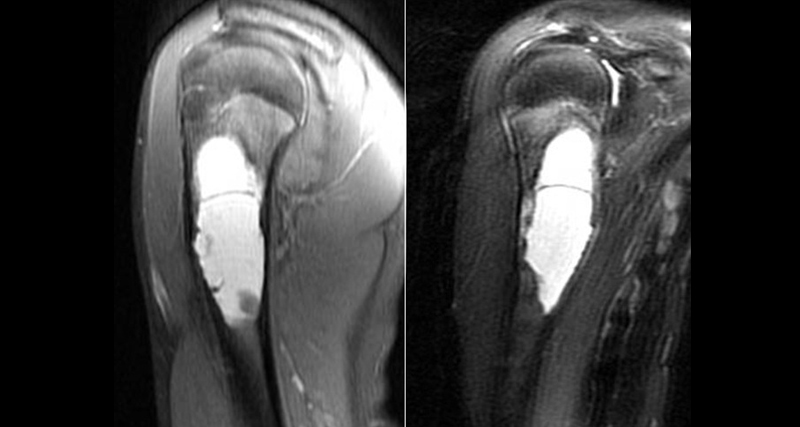 MRI scans showing bone cysts in the upper arm, typically used in diagnosis and follow-up imaging.
