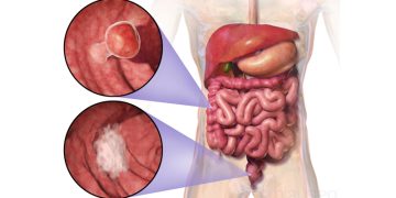 Medical diagram showing location and close-up views of bowel cancer in the digestive tract