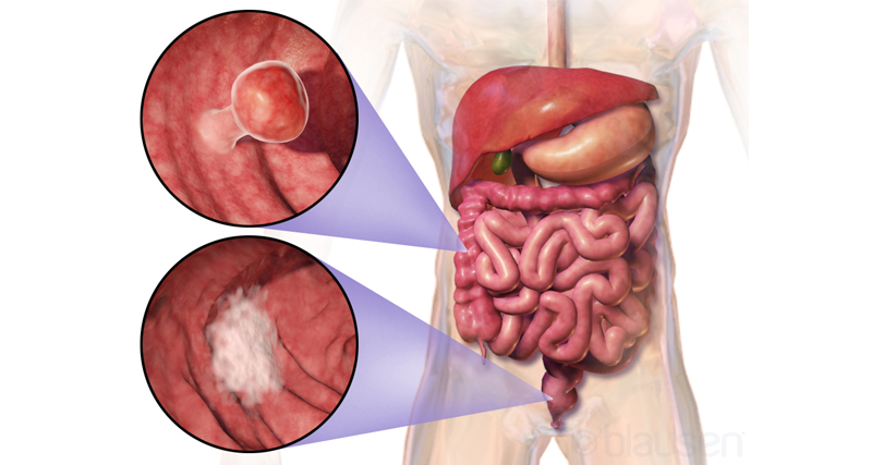 Medical diagram showing location and close-up views of bowel cancer in the digestive tract