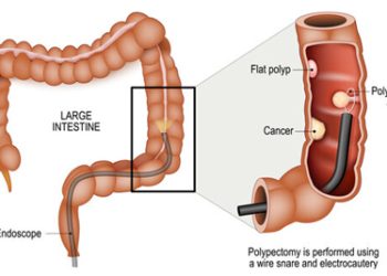 Illustration of bowel polyps inside the large intestine during an endoscopic procedure
