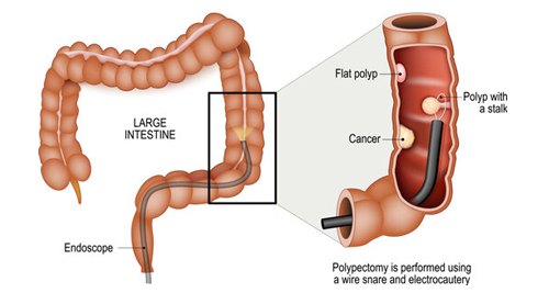 Illustration of bowel polyps inside the large intestine during an endoscopic procedure