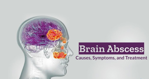Brain Abscess